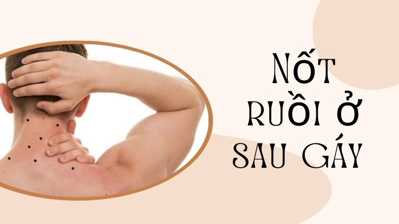 Nốt ruồi ở sau gáy - Chỗ dựa vững chắc về kinh tế